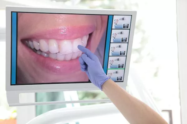 Bei Parodontose: Zahnfleischlifting Bild: Bei Parodontose: Zahnfleischlifting