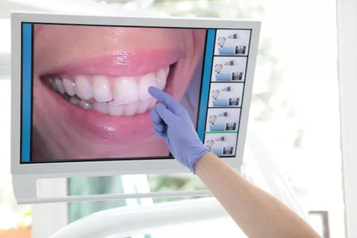 Bild: Bei Parodontose: Zahnfleischlifting