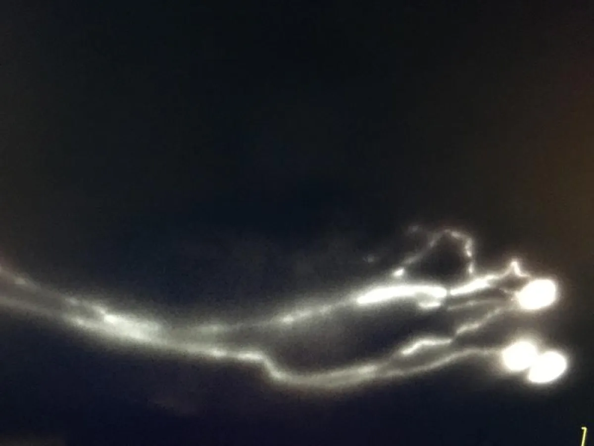 Darstellung der Lymphgefäße aus Hand und Unterarm mithilfe einer Fluoreszenzkamera.