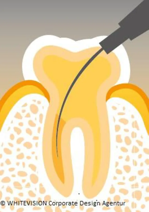 Sanfte Wurzelbehandlung mittels Endometrie und reziproker Wurzelkanal-Aufbereitung