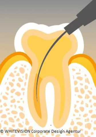 Vor, zurück und ringsherum – gründlich und schnell ist die Wurzelbehandlung um Bild: Vor, zurück und ringsherum – gründlich und schnell ist die Wurzelbehandlung um