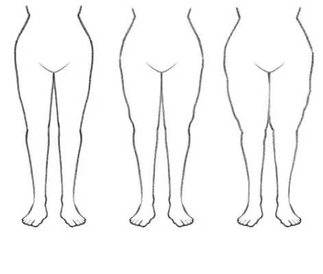 Bild: Das oft vernachlässigte Lipödem