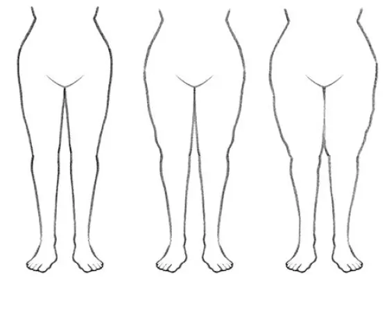 Bild: Das oft vernachlässigte Lipödem