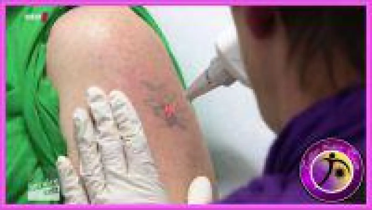Tattoo Laser Team