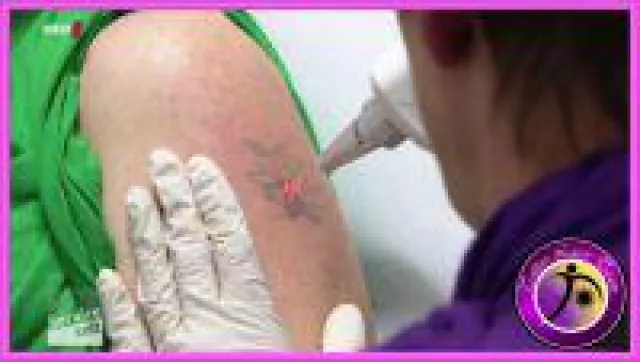 Bild: Fakten zur Laser Tattooentfernung