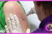 Fakten zur Laser Tattooentfernung Bild: Fakten zur Laser Tattooentfernung