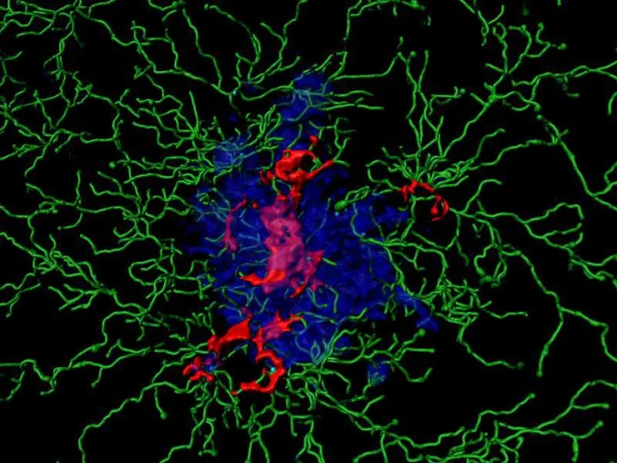 Bild: Entzündungsmechanismen treiben Alzheimer-Erkrankung voran