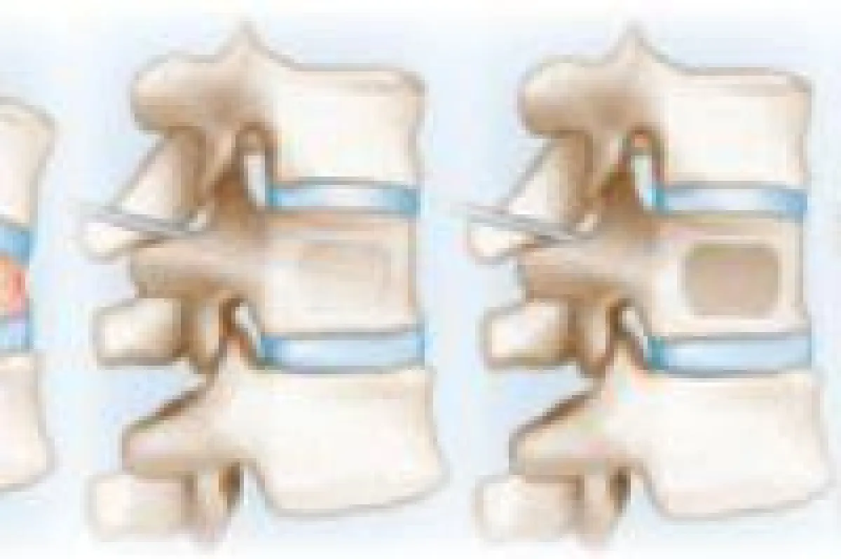 Apex-Spine Kyphoplastie