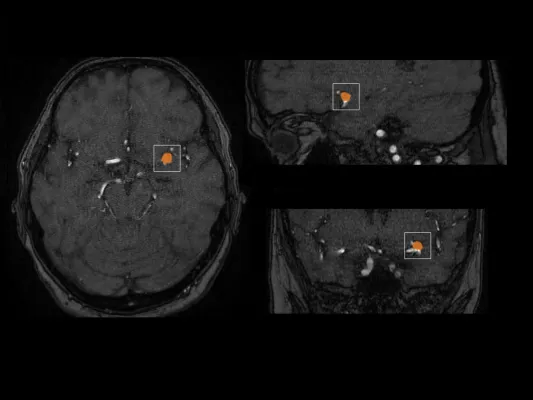 Bild: mediaire führt weltweit ersten neuroradiologischen KI-Assistenten zur Detektion von Aneurysmen ein