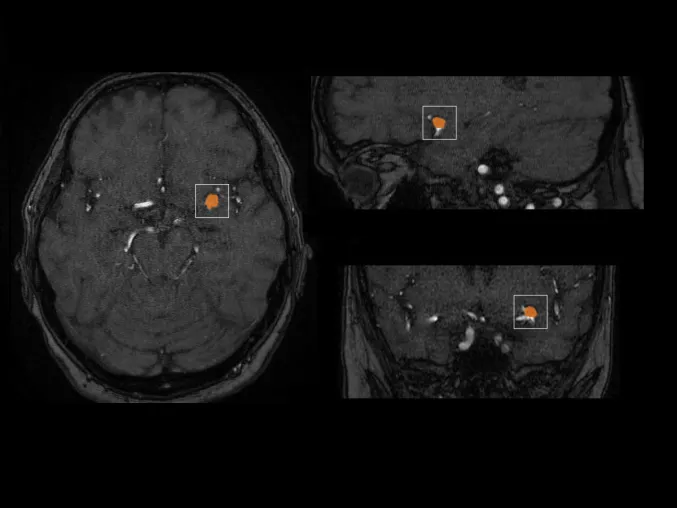 Bild: mediaire führt weltweit ersten neuroradiologischen KI-Assistenten zur Detektion von Aneurysmen ein