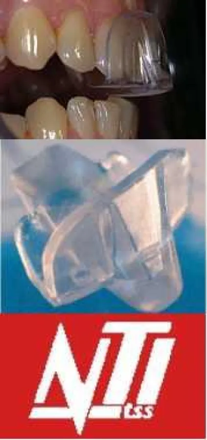 NTI-tss: Kleine Schiene mit großer Wirkung bei Bruxismus, Kopf- und Spannungsschmerzen