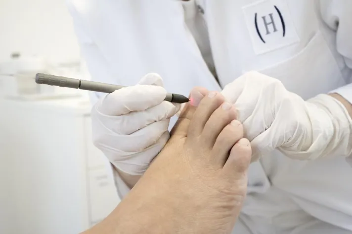 Bild: NEUE BEHANDLUNGSMÖGLICHKEIT BEI NAGELPILZ