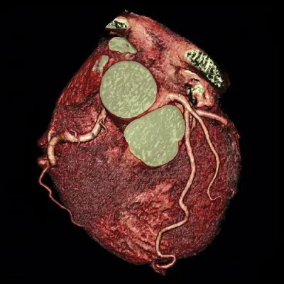 Schneller als jedes Herz – Elisabeth-Krankenhaus Essen nimmt den weltweit modernsten Computertomographen in Betrieb Bild: Schneller als jedes Herz – Elisabeth-Krankenhaus Essen nimmt den weltweit modernsten Computertomographen in Betrieb