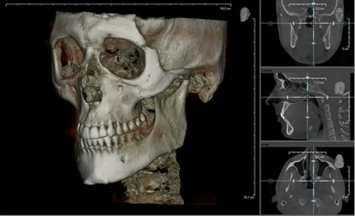 3D-Röntgenbild in der Zahnmedizin