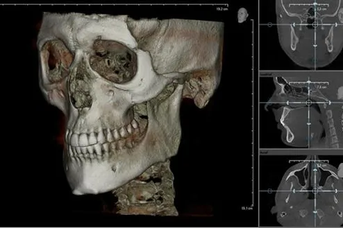 Bild: Hilfe, ich brauche ein Zahn-Implantat