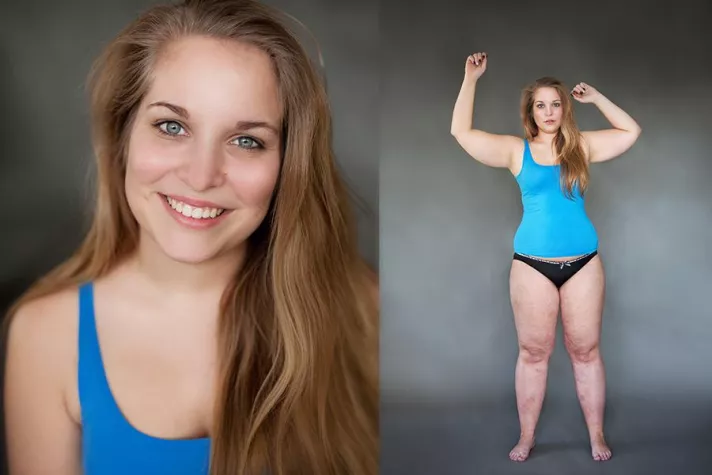 Bild: „Unheilbar!“ Lipödem im Fokus durch prominente Patientinnen