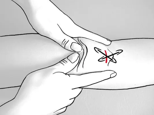 Bild: Nach OP: Störenden Narben vorbeugen