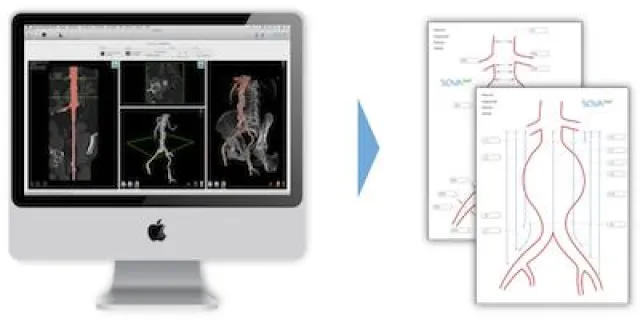 Bild: Lebenserhaltende Software für die Therapie von Aortenaneurysmen von SOVAmed aus Koblenz