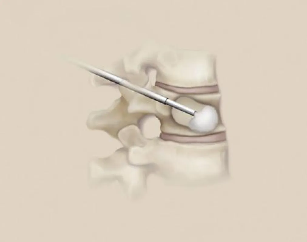 (Bild: Medtronic) Der durch das Ausdehnen des Ballons entstandene Hohlraum wird mit zähflüssigem Knochenzement gefüllt – und wie durch einen Gips stabilisiert.