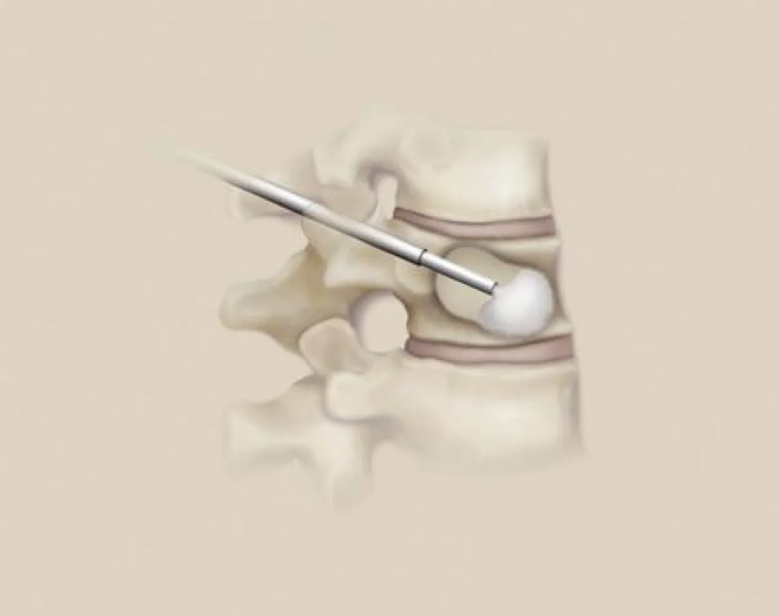 (Bild: Medtronic) Der durch das Ausdehnen des Ballons entstandene Hohlraum wird mit zähflüssigem Knochenzement gefüllt – und wie durch einen Gips stabilisiert.