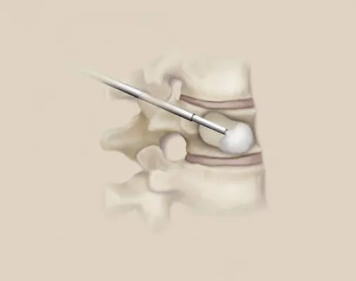 Bild: Frühtherapie bei osteoporotischen Brüchen wichtig: Ballon-Kyphoplastie – kurzer Eingriff statt langen Leidens