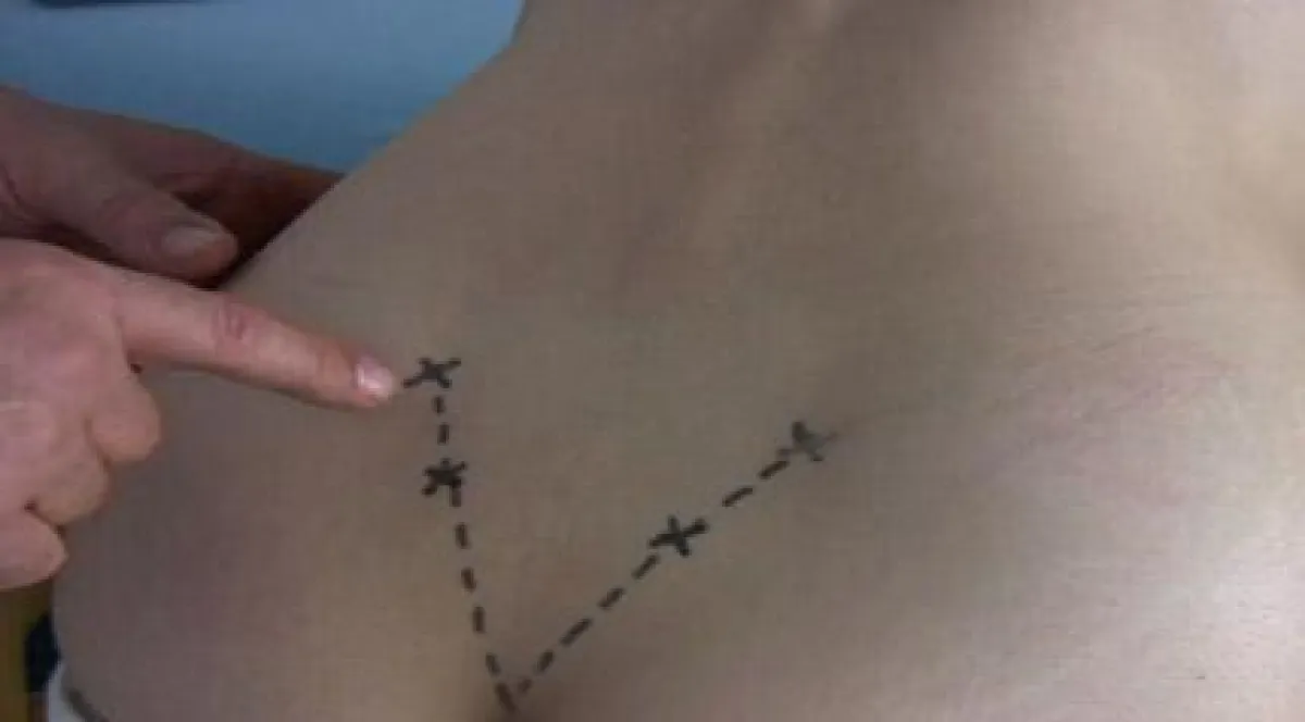 Palpationspunkte des Beckens mit der