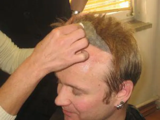 Bild: Schnelle Hilfe bei Haarausfall und kahlen Stellen