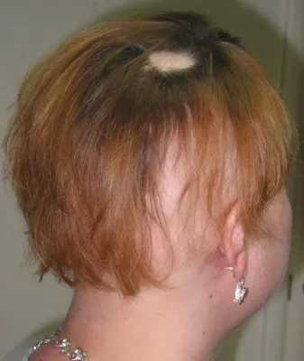 Bild: Haare können auf Kahlstellen wachsen