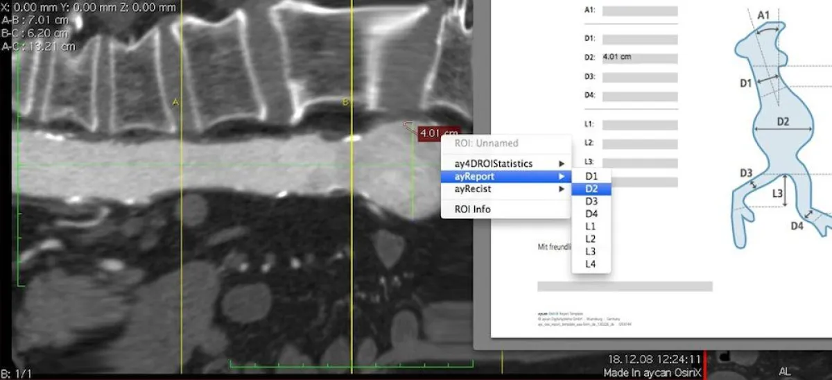 Direktes Reporting in aycan OsiriX PRO