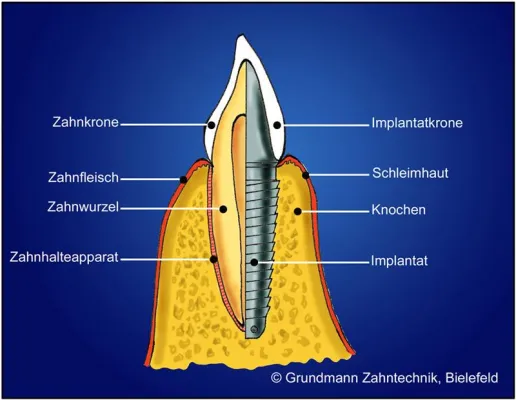 Bild: 10.000 versorgte Implantate - Meilenstein in der Zahntechnik erreicht