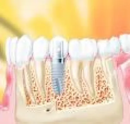 Seminar: Implantologie Ahaus mit OA Dr. Paul Wiegl und Olaf van Iperen Bild: Seminar: Implantologie Ahaus mit OA Dr. Paul Wiegl und Olaf van Iperen