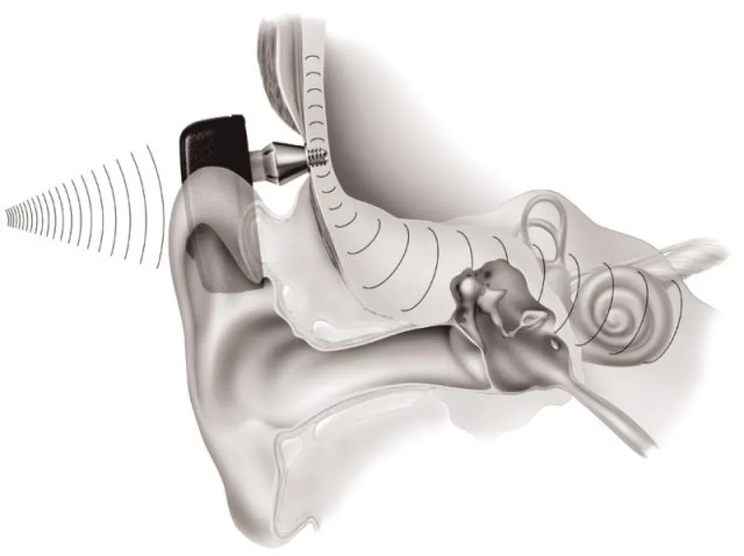 Schallübertragung mittels Knochenleitung – das Cochlear™ Baha®-System (Foto: Cochlear)