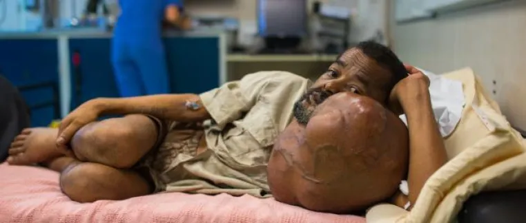 Bild: 7,5 kg schwerer Tumor bei 60-jährigem Mann auf Madagaskar entfernt