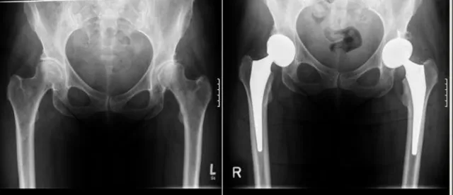 Bild: Informationsabend in Eningen zum Thema Gelenkersatz und Demenz