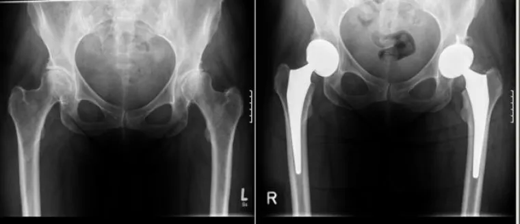 Bild: Informationsabend in Eningen zum Thema Gelenkersatz und Demenz