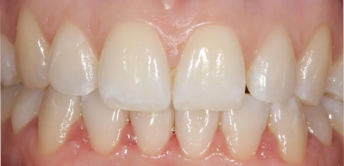 optimiertes Ergebnis der Zahnstellung mit der Secret Smile Schiene