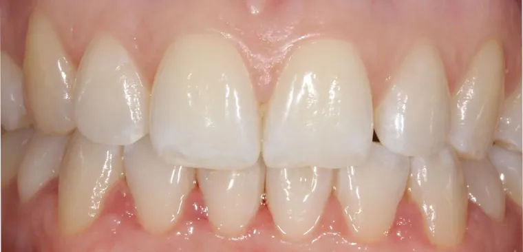 Bild: Secret Smile Schienen: Zahnkorrektur, die keiner sieht