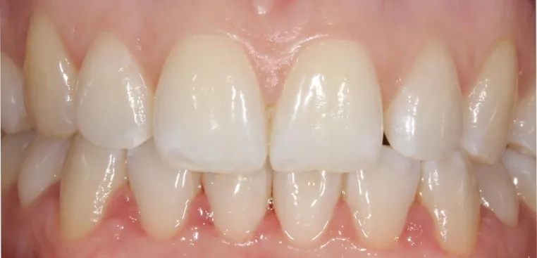Bild: Secret Smile Schienen: Zahnkorrektur, die keiner sieht