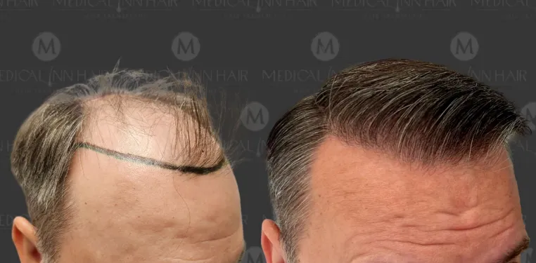 Bild: Innovative KI-Analyse revolutioniert den Bereich der Haartransplantation