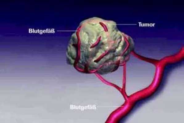 Bild: Nierenkrebs – Aktuelles zur Therapie und Krankheitssituation in Deutschland