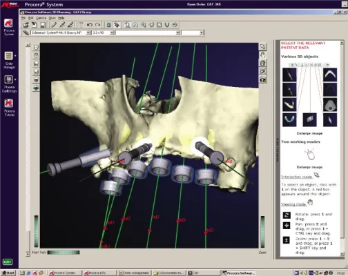 Begriffe rund ums Zahnimplantat - GZFA erklärt Fachbegriffe Bild: Begriffe rund ums Zahnimplantat - GZFA erklärt Fachbegriffe