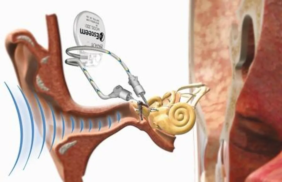 Illustration des Esteem ® von Envoy Medical