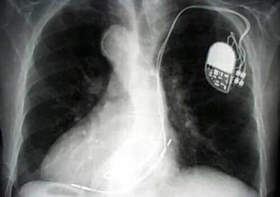 Bild: Herzschrittmacher im Einsatz