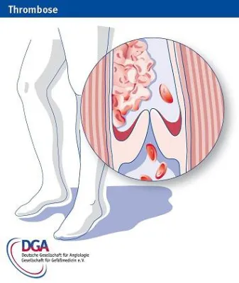 Bild: Welt-Thrombose-Tag am 13.Oktober: Korrekte Behandlung entscheidet über Leben und Tod