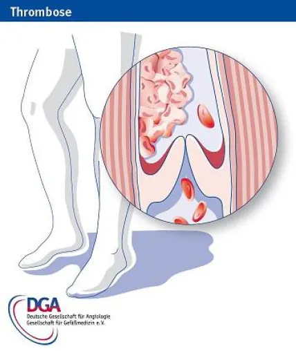 Welt-Thrombose-Tag am 13.Oktober: Korrekte Behandlung entscheidet über Leben und Tod Bild: Welt-Thrombose-Tag am 13.Oktober: Korrekte Behandlung entscheidet über Leben und Tod