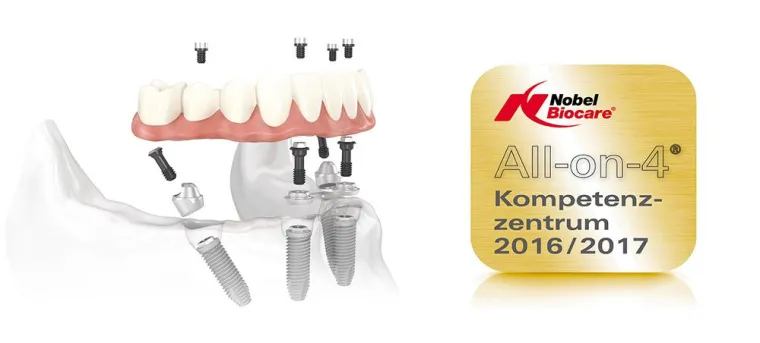 Bild: All-On-4® – Feste Zähne an einem Tag.