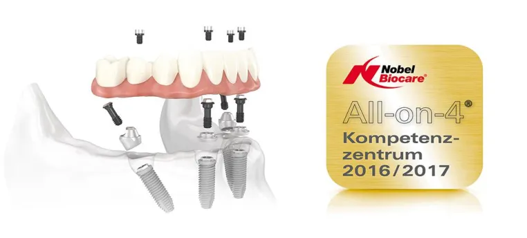 Bild: All-On-4® – Feste Zähne an einem Tag.