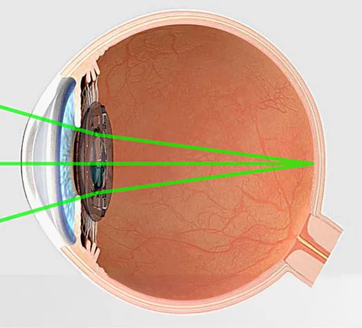 Bild: Klar sehen ohne Brille: 95% der Patienten sind zufrieden