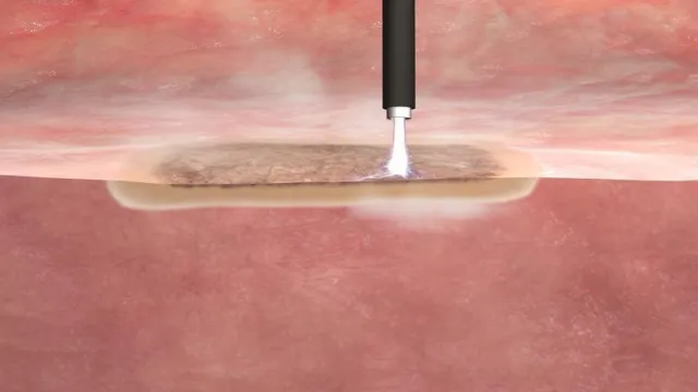 Neuer Ansatz zur Therapie von Fettleibigkeit Bild: Neuer Ansatz zur Therapie von Fettleibigkeit