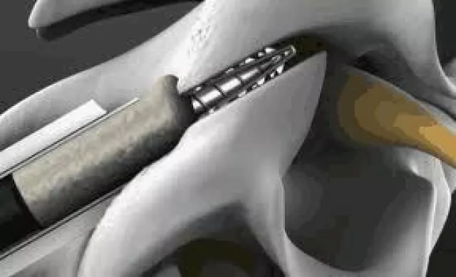 DTRAX - Perkutanes Verfahren zur Dekompression und Fusion der HWS Bild: DTRAX - Perkutanes Verfahren zur Dekompression und Fusion der HWS